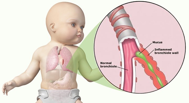 Bronquiolite: a principal causa de morte infantil e formas de prevenção