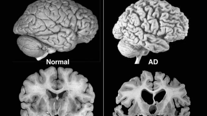 alzheimer6